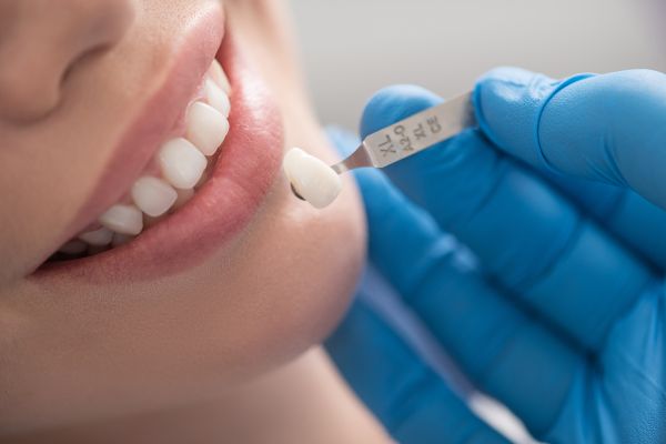 A close-up of a dentist holding a dental veneer near a patient’s teeth to check the color match before placement.
