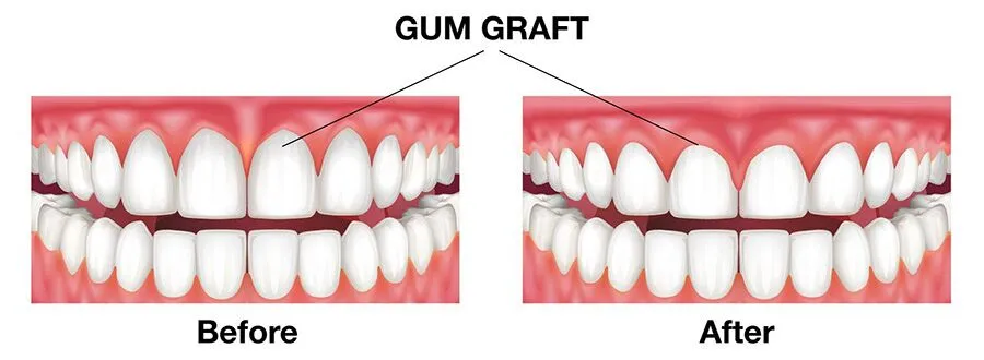 Illustration showing teeth and gums before and after a gum graft procedure to treat gum recession