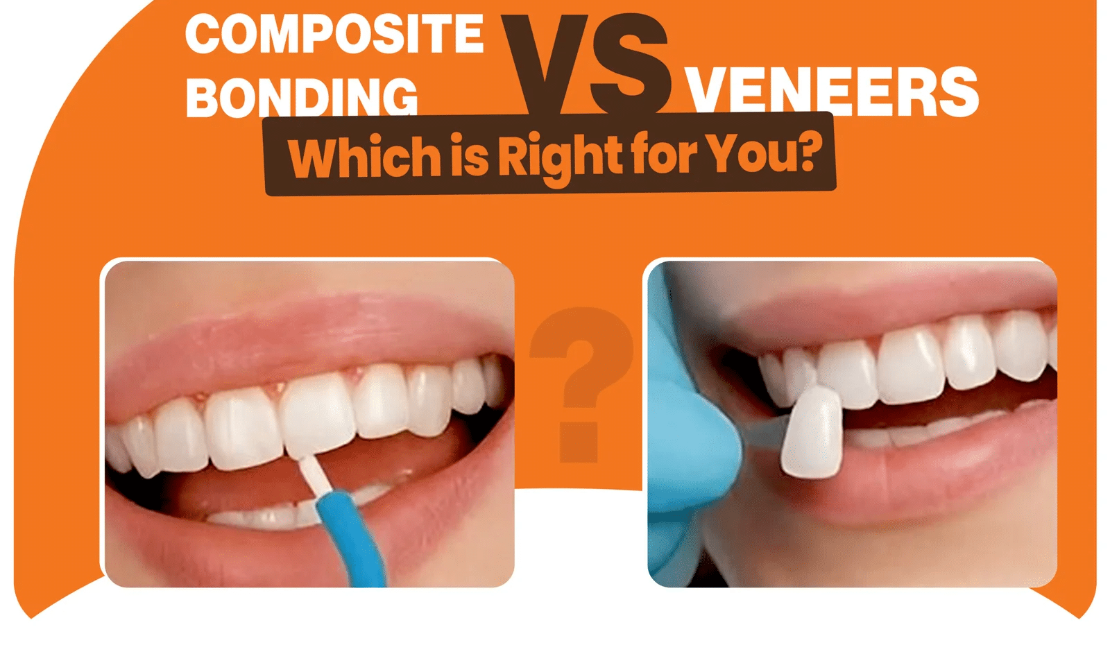 Composite dental bonding compared with porcelain veneers showing cosmetic tooth restoration options