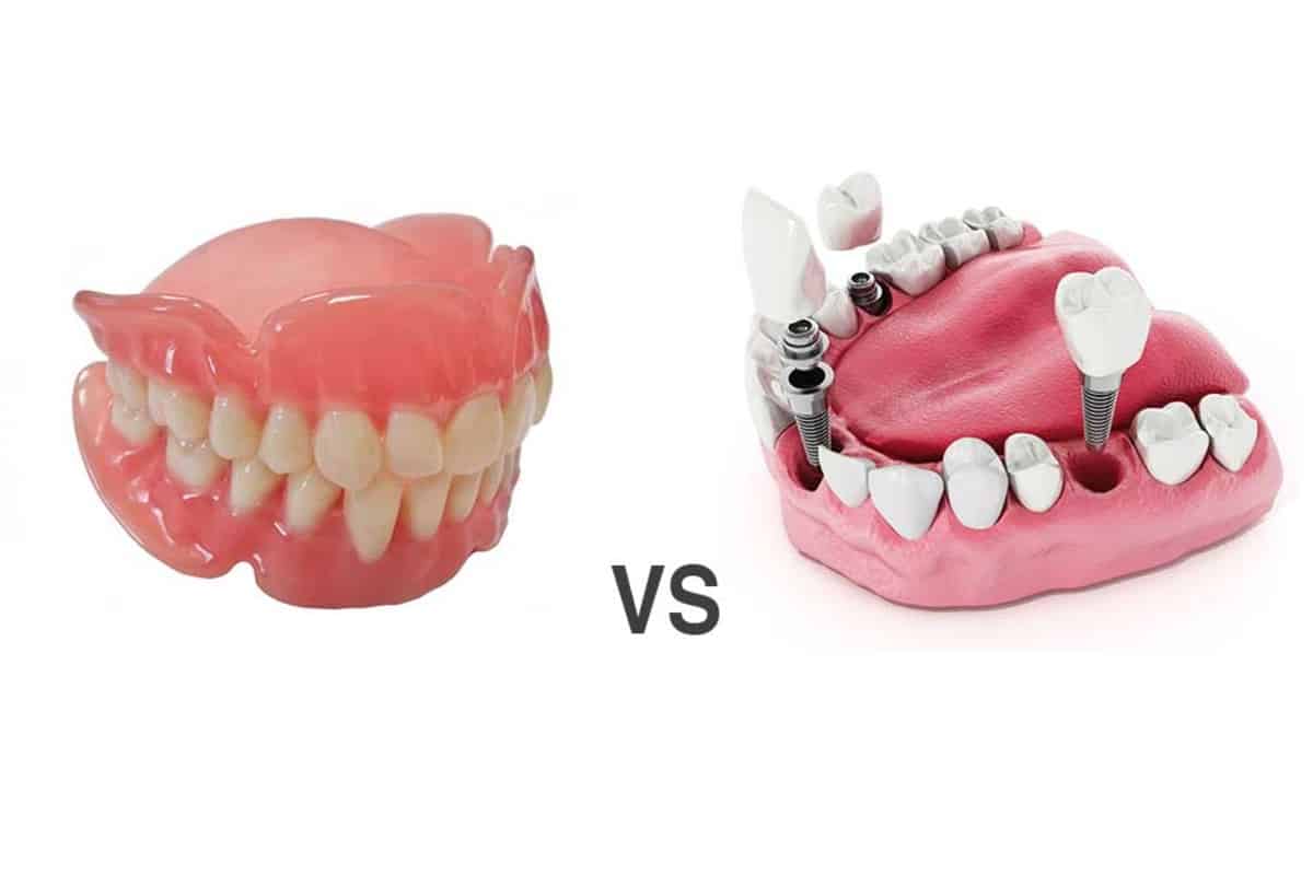 Illustration showing the difference between a dental crown and dental filling used to restore damaged teeth