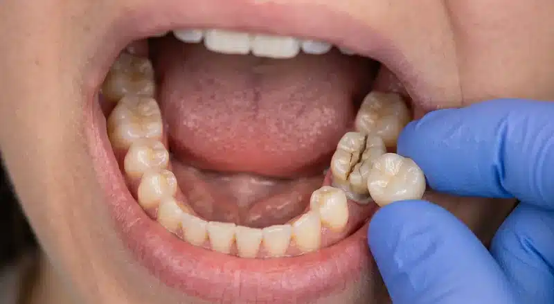 Close-up of a cracked lower molar being examined by a dentist wearing blue gloves.