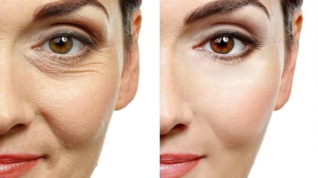 Side-by-side close-up of a person's face showing visible wrinkles around one eye compared with a smoother appearance on the other side.